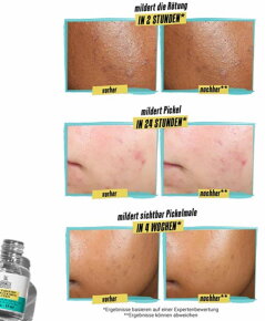 Kiehl's Truly Targeted Blemish Clearing Solution 15 ml